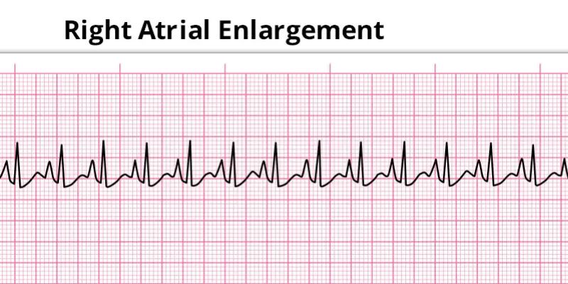 What Is Right Atrial Enlargement Mean